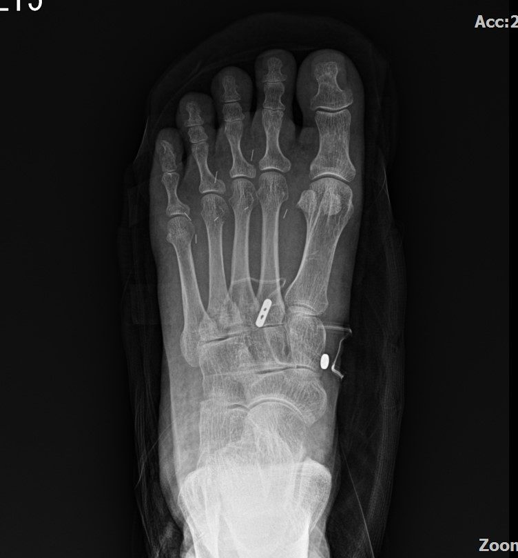 Lisfranc 손상 고정술